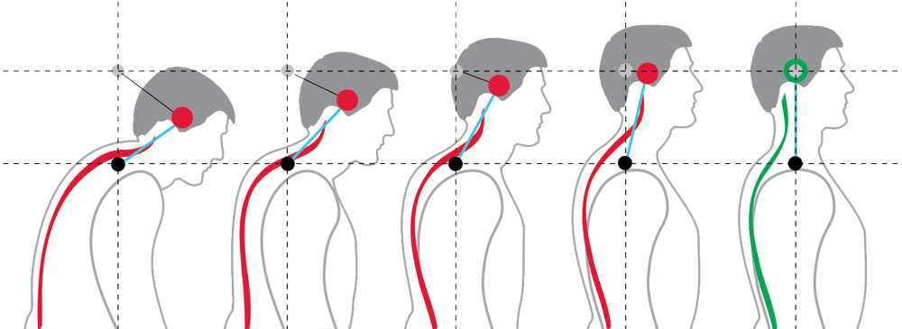 posture correction vancouver