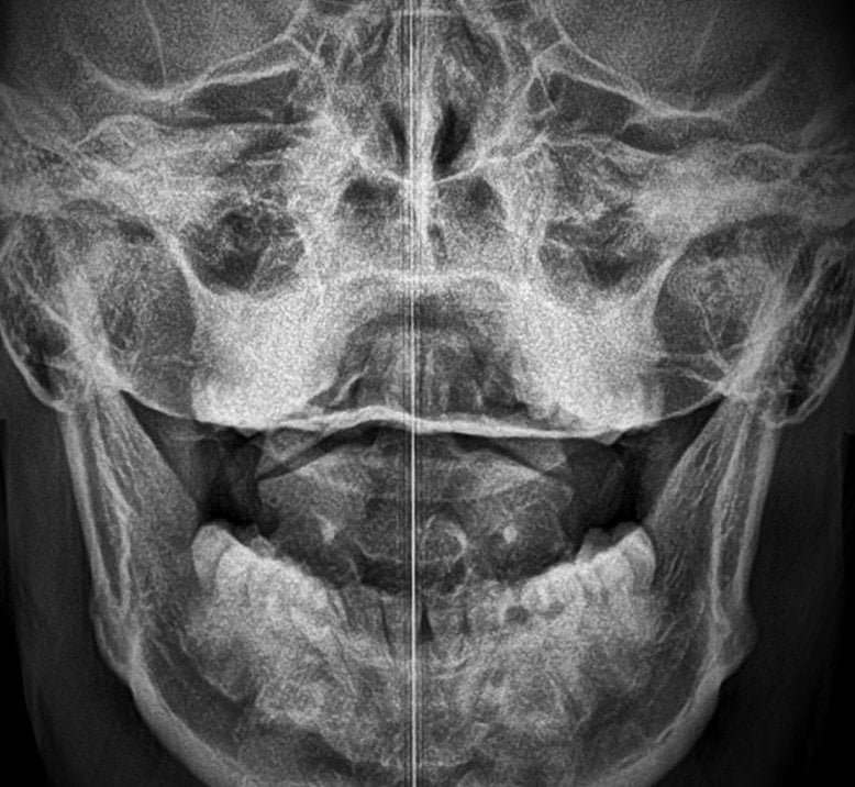 upper cervical atlas